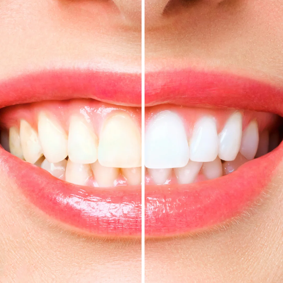 Wybielanie Zębów w Gabinecie – Wszystko, Co Musisz Wiedzieć o Śnieżnobiałym Uśmiechu